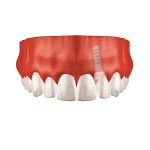 Implant3.1 Zahnarzt Saarbrücken Implantate Einzelzahnersatz 3